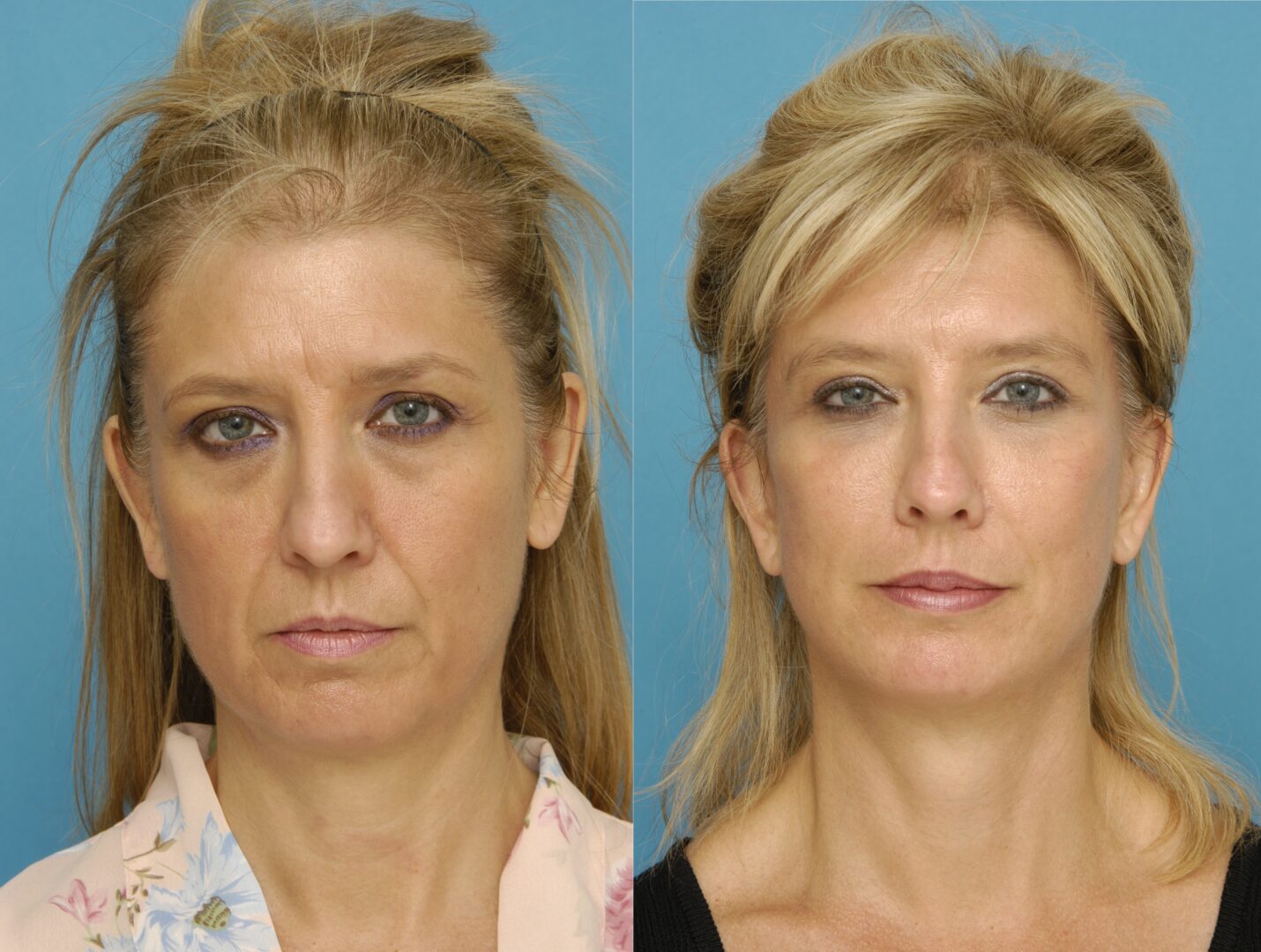 Facial rejuvenation treatments orlando