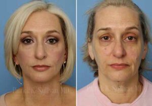 A woman with blonde hair and blue eyes is before and after surgery.