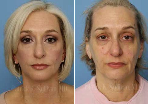 Facelift Face Lift Surgery Providence Rhode Island RI