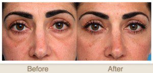 A woman 's eyes before and after using the eye cream.