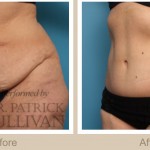 A before and after picture of an abdominoplasty procedure.