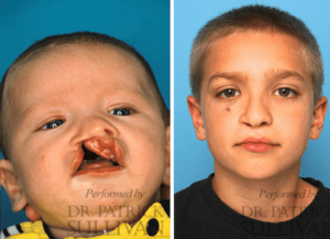 A before and after photo of a child with an open mouth.
