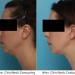 A woman 's face before and after chin / neck contouring.
