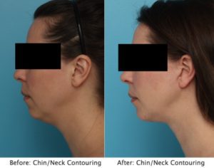 A woman 's chin and neck contouring before and after