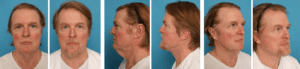 A man with long hair and a beard is shown before and after surgery.