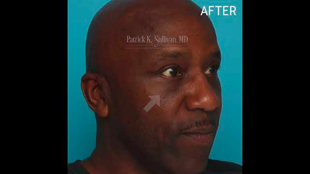 Eyelid surgery and Fat Injection Before & Afters by Dr Patrick K Sullivan