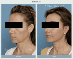 A woman with a facelift and chin implant before and after surgery.
