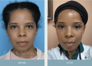 A before and after picture of a woman 's face.