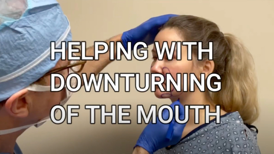 Helping with Downturning of the Mouth